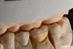 Natural Looking Emax Inlay Onlay Long Lasting Dental Restoration 0.5mm 1mm 1.5mm