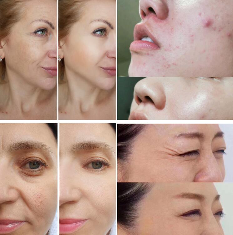 CE FDA Multifunction Photon Facial Beauty Mask For Yellow Dull Shiny Face