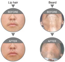 Home Used Diode Laser Hair Removal Machine With Big Spot Size Treatment Head