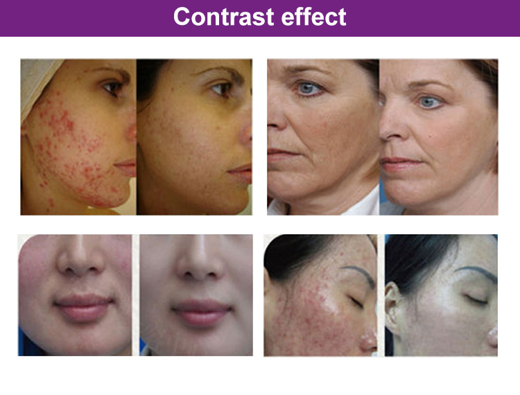 Best Red Light Therapy Devices For Beauty Salon Customize Photodynamic Therapy Machine for Skin Care
