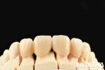 High Translucency Layered Zirconia 3 W/mK Thermal Conductivity For Exceptional