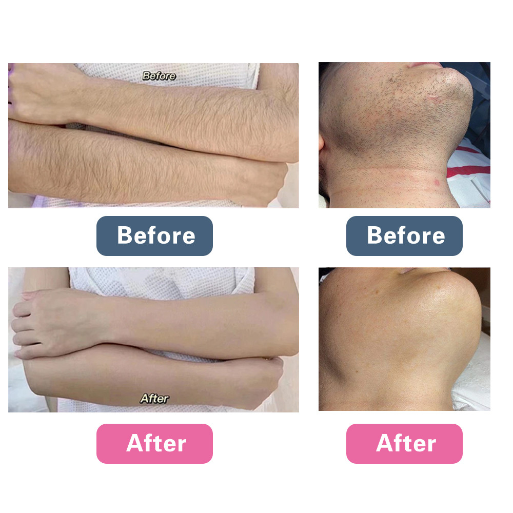 Medical Grade Titanium Diode Laser Hair Removal Machine 4 Waves