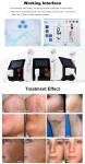 D32 Portable 808nm Professional Homeuse Diode Laser Hair Removal Machine Seeking