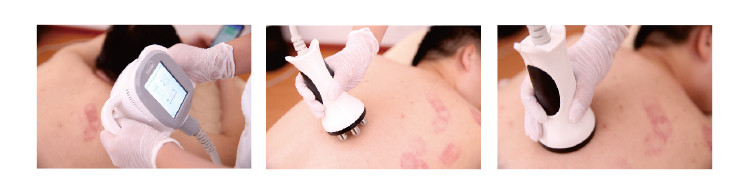RF System 40K Cavitation Vacuum Slimming Machine Liposuction Weight Loss Machine
