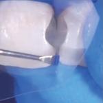 Anterior Matrix Strips Dental Roll Dental Resin Strip Roll