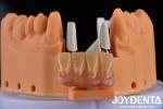 4.5mm Height Finished Abutments Internal Hex Connection Type Compatible With