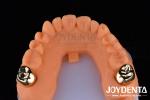 Dental Restoration Gold Metal Crowns for Oral Rehabilitation Treatment