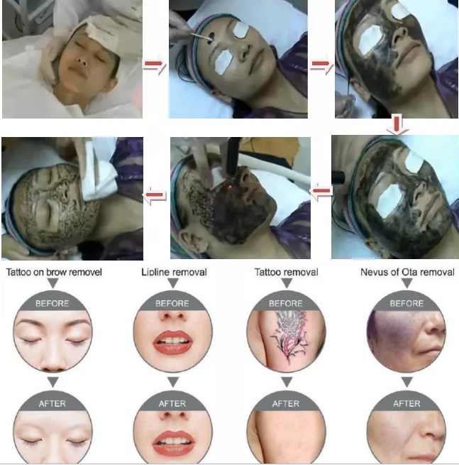 1064nm 532nm 1320nm Nd Yag Laser Equipment Portable For Skin Whitening
