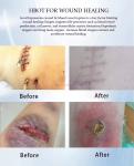 Medical Spa Lying Hyperbaric Chamber Oxygen Home Camara Hiperbaricas Improve