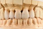 Highly Customizable Layered Zirconia Dental Crowns And Bridges Long Lasting