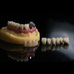 Porcelain Ceramic PFM Dental Crown Material For Restoration