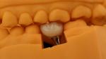 Screw Retained Dental Implant Crown Dental PFM Crown With 3D Print Model