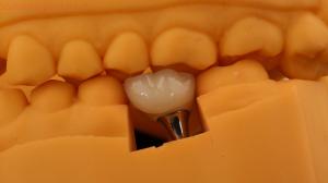 Quality Screw Retained Dental Implant Crown Dental PFM Crown With 3D Print Model wholesale