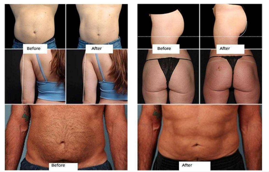 Non Invasive Body Sculpting Machine , Magnetic Muscle Stimulation Machine