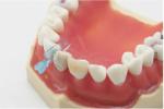 High Quality Dental Wedges Disposable Dental Elastic Wedge Medical Dental