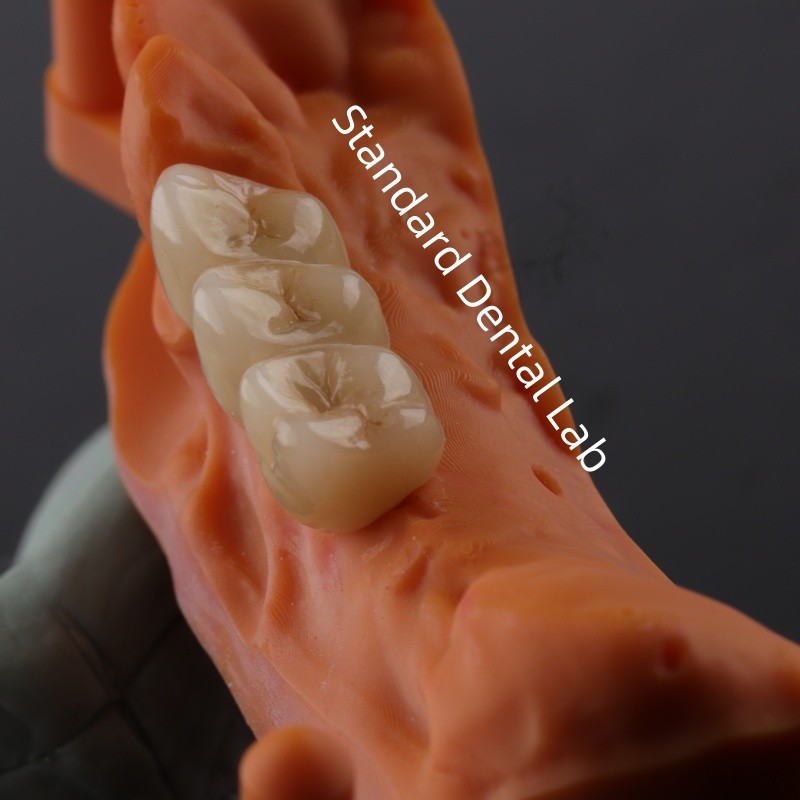 Digital CAD CAM Dental Lab Crowns Translucent Layered Zirconia Crown