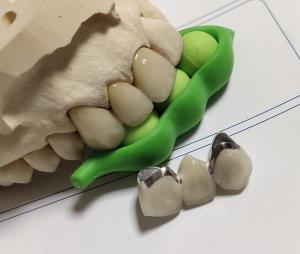 Quality Porcelain CAD CAM PFM Crown wholesale