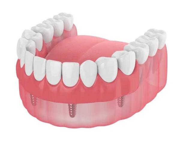 Dentures Missing Teeth Dental Implant Bar Fillings Dentures Temporary Removable