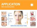 400mj CO2 Fractional Laser Machine 60W female intimate areal Rejuvenation