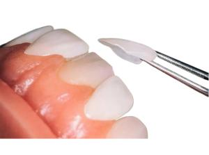 Quality Custom OEM Dental Porcelain Veneer Firm Wear Resistant For Dental Restoration wholesale