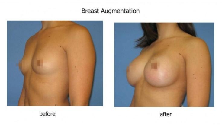 Hyaluronic Acid Breast Filler 10ml , Women Breast Augmentation Injection Filler