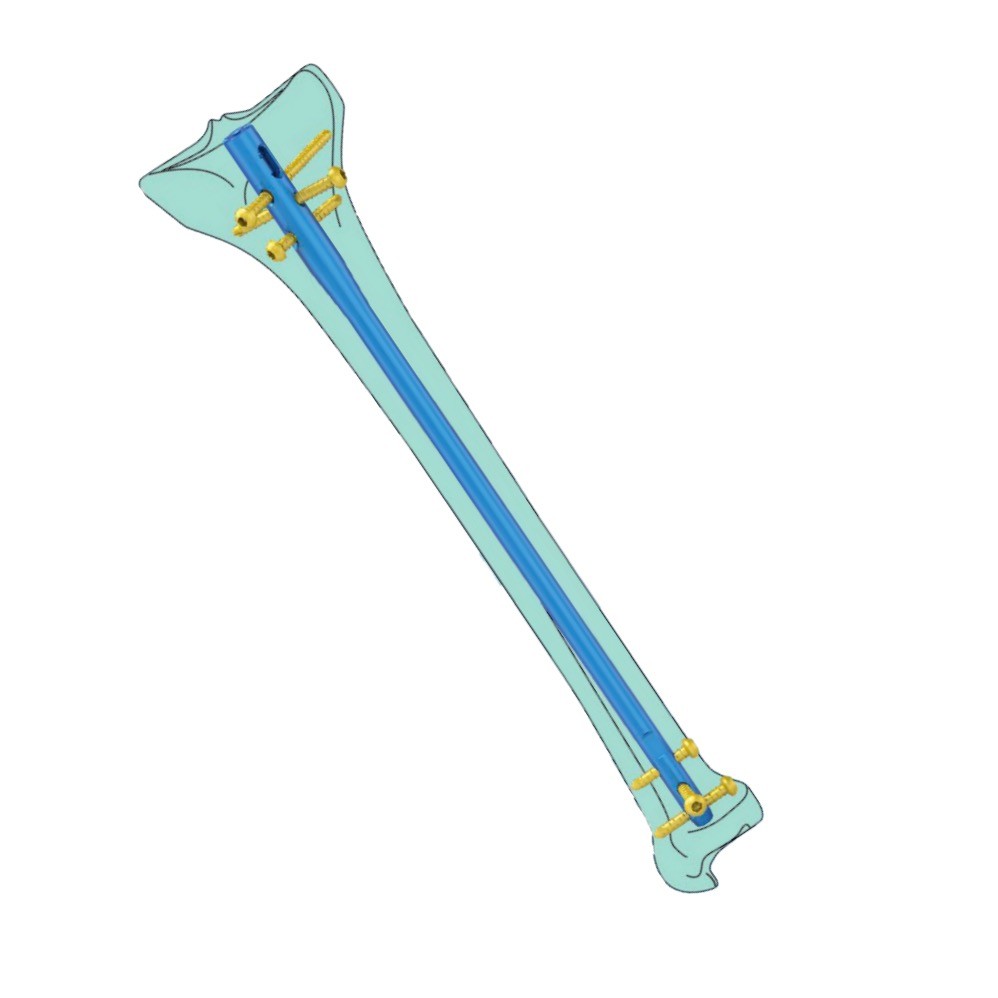 Titanium Intramedullary Nail System Orthopedic Proximal Femoral