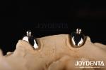 Joydental dental lab Ball Attachment