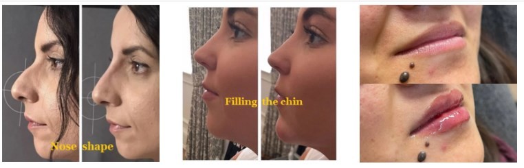 Fine / Derm / Deep Ha Filler Hyaluronic Acid Filler Face Wrinkles 5ml