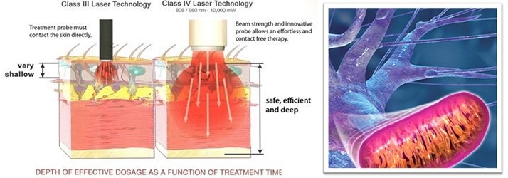 650nm Class 4 Laser Therapy Machine Four Wavelengths Class Ⅳ Therapy Laser