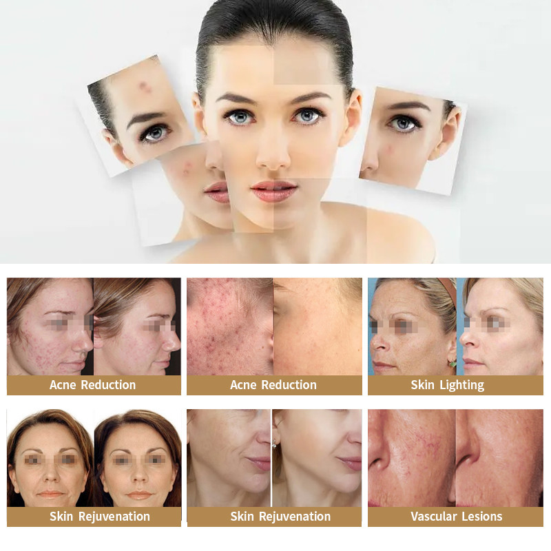 Permanent Opt Shr Ipl Laser Skin Rejuvenation Elight