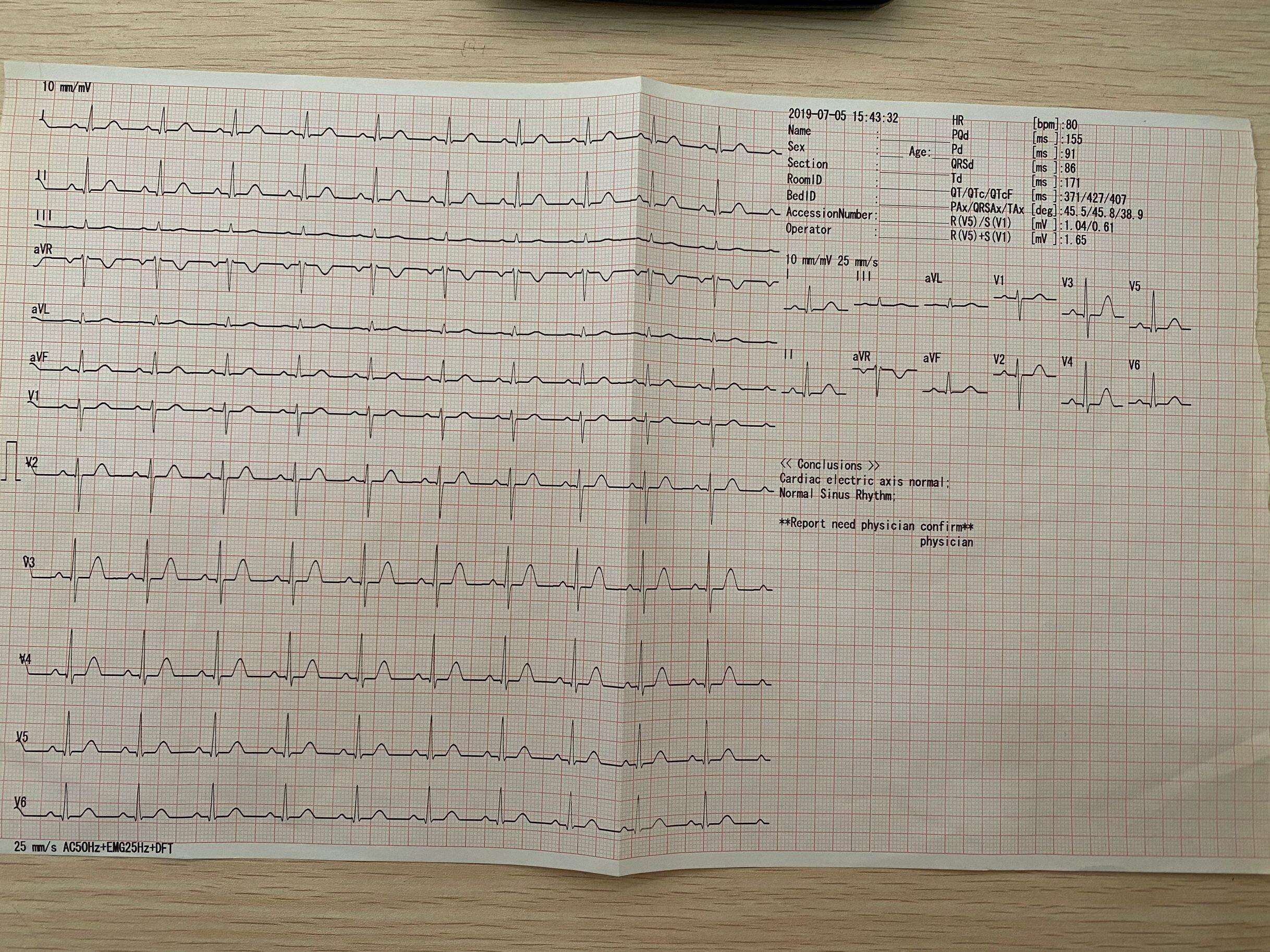 3 6 12 Channel ECG Machine Digital EKG Cardiograph for Hospital Cheap Price