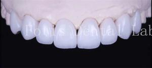 Quality Adhesive Bonding Cement Natural White Veneers With High Translucency wholesale