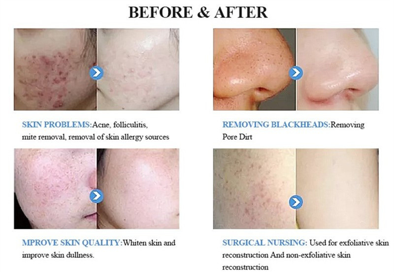 Vertical Hydro 14 in 1 Microcurrent Peeling Facial Care Dermabrasion Device