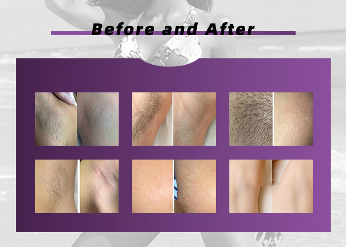 Permanent 808nm Diode Laser Hair Removal Machine TUV MED CE Approved
