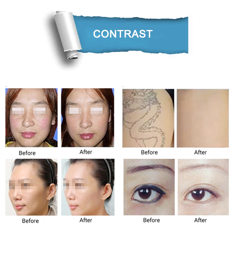 SP1multifunctional skin tightening Q Switched Laser Beauty Machine new technologies Co2 fractional laser pigment removal