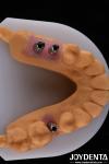 Porcelain Implant Crown and Bridge The Ultimate Solution for Restoration Of