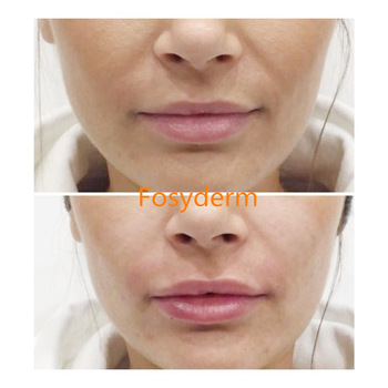 Anti Wrinkle Dermal Filler Hyaluronic Acid Facial Filler Injection 2ml Deep