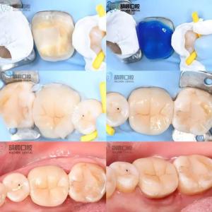 Quality Experience The Precision Of Dental Inlay Affordable And White For Perfect Fit wholesale