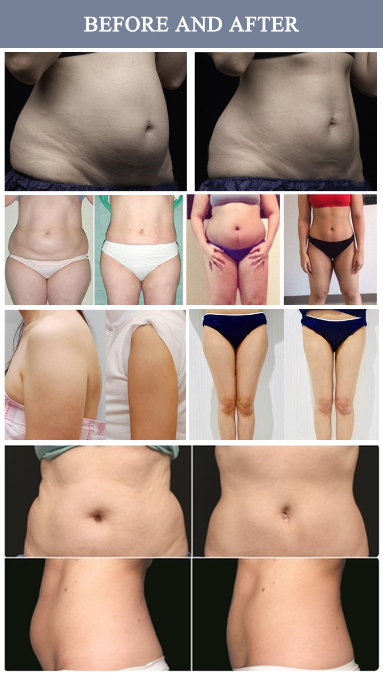 Shaping FDA Approved Laser Lipo Sculpt Machine Auto Mode / Manual Mode