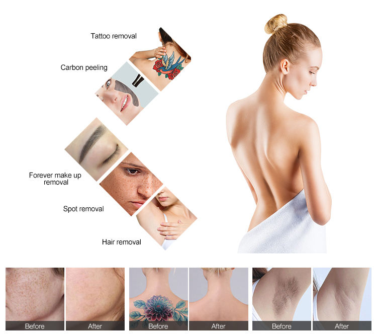 Custom Multifunctional Beauty Machine 808nm Q Switched Nd YAG Laser For Skin Lightening