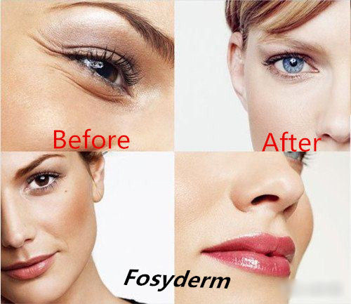 1ml Stable Cross Linked Hyaluronic Acid Filler Injections For Crow's Feet