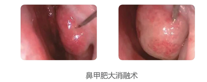 Low Temperature RF Plasma System Cutting Perforation Ablation Cryosurgery Unit