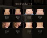 Ultrasound Cavitation Machine 80k Vacuum RF Slimming Weight Loss Body Shape