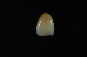 Quality ADS Dental Lab Dental Veneer Zirconia Stain Lifelike Finish OEM wholesale