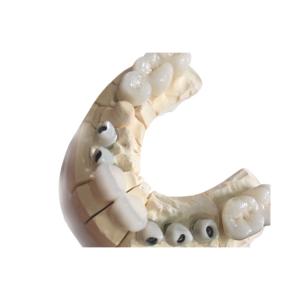 Quality Metal Free White Zirconia Dental Crowns Excellent Biocompatibility wholesale
