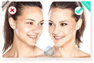 Quality 135 HA Mesotherapy Serum FILORGA 5*3ml Skin Booster Rejuvenation wholesale