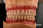 Lightweight Comfortable Fit Acrylic Dental Denture Finish Professional