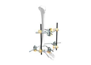 Quality Children’S Femur Spanning External Fixation System In Fracture Treatment wholesale