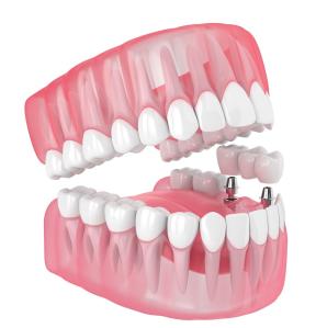 Quality Single All Ceramic Teeth Dental Implants Missing Filling Dentures Wisdom Teeth wholesale