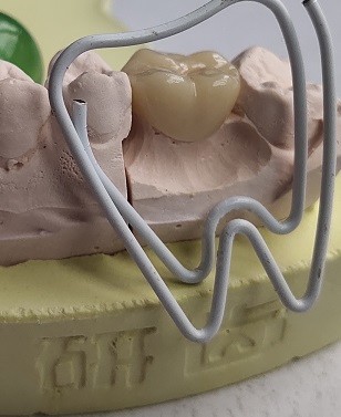 Natural Colour Resin Based Composite Crowns